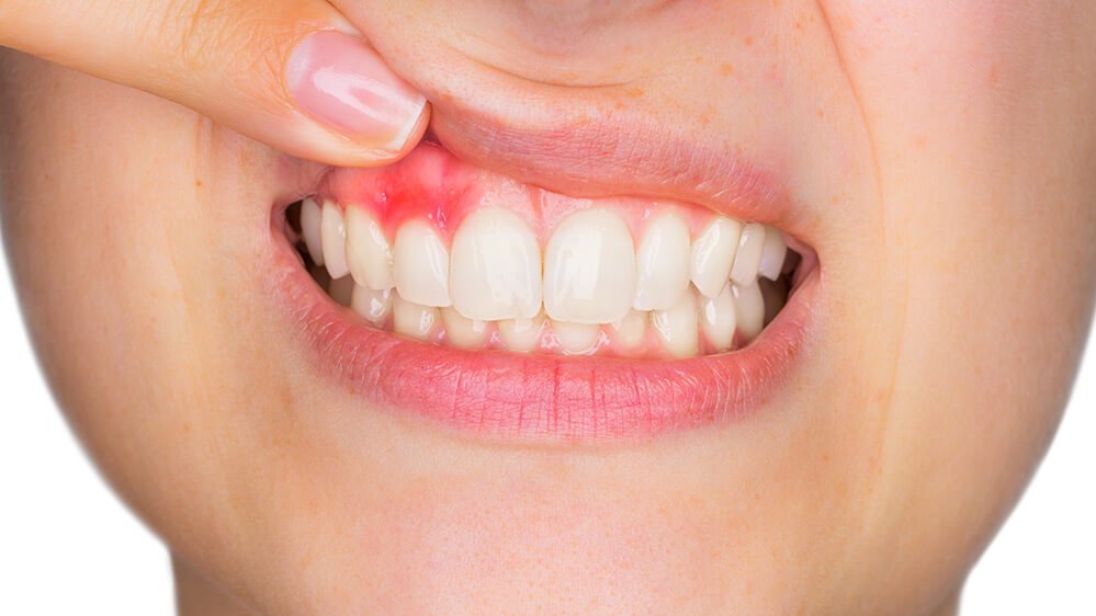 Gingivitis