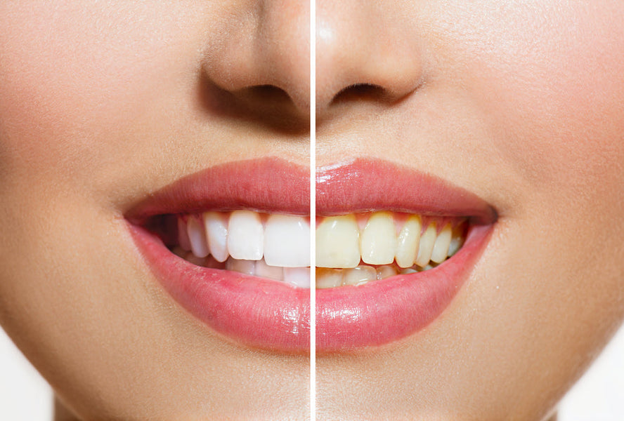 Why Are My Teeth Yellow When I Brush Them Everyday?
